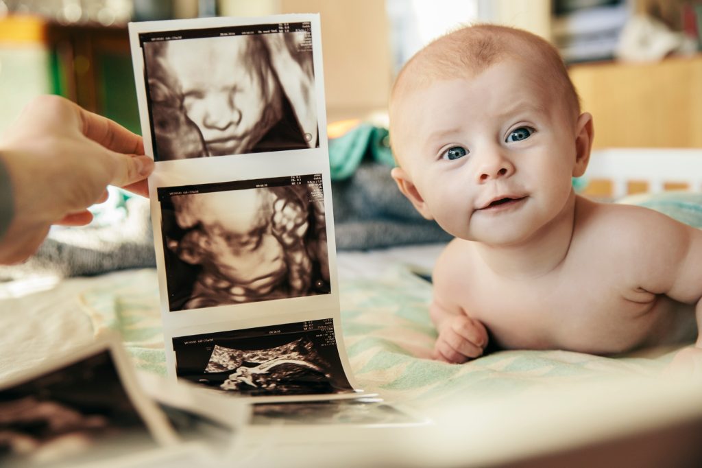 Baby being compared to early 3D ultrasound pictures of itself
